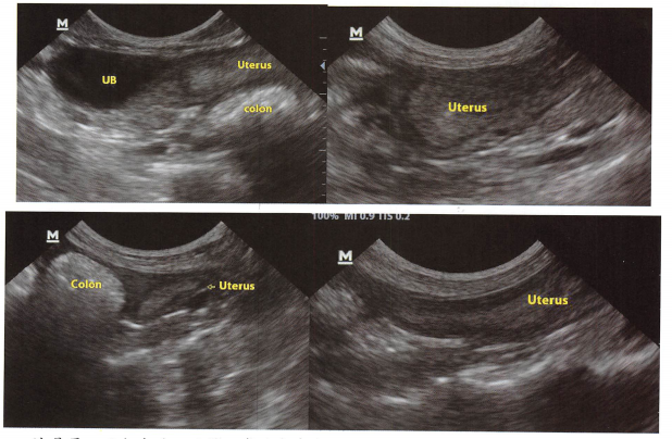 这是另一只犬产后5天的正常子宫声像。Uterus子宫,colon结肠,UB膀胱。后面有 手绘图,子宫、结肠、膀胱的三角关系。 这是另一只犬产后5天的正常子宫声像。Uterus子宫,colon结肠,UB膀胱。后面有 手绘图,子宫、结肠、膀胱的三角关系。