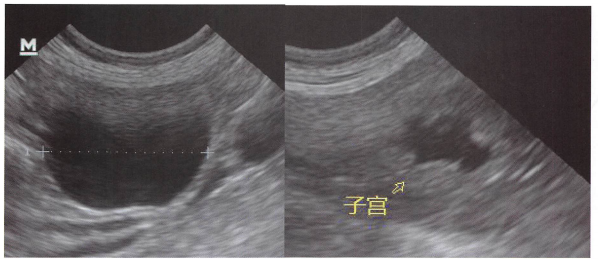 老年苏牧犬,卵巢囊肿(左图)合并子宫蓄脓(右图)。上图为该病例的手绘模式图。有时候子宫蓄脓是多个有分隔的液性暗区,不利于与卵巢囊肿区别。可通过以下方法:卵巢囊肿必然位于肾后,而子宫蓄脓则从肾后到膀胱两侧都有可能存在,另一方面卵巢囊肿的壁薄,蓄脓子宫的壁通常较厚。 老年苏牧犬,卵巢囊肿(左图)合并子宫蓄脓(右图)。上图为该病例的手绘模式图。有时候子宫蓄脓是多个有分隔的液性暗区,不利于与卵巢囊肿区别。可通过以下方法:卵巢囊肿必然位于肾后,而子宫蓄脓则从肾后到膀胱两侧都有可能存在,另一方面卵巢囊肿的壁薄,蓄脓子宫的壁通常较厚。