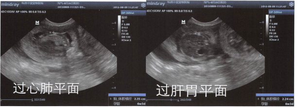 体腔横径的测量:过肺心平面测量时包含体腔壁;过肝胃平面测量时不包括体腔壁,因出生前胎儿体横径最粗部分是肝胃部分,比心肺平面粗。见上面两张实拍照片。参考第二张实拍图(小狗侧躺这张)。 体腔横径的测量:过肺心平面测量时包含体腔壁;过肝胃平面测量时不包括体腔壁,因出生前胎儿体横径最粗部分是肝胃部分,比心肺平面粗。见上面两张实拍照片。参考第二张实拍图(小狗侧躺这张)。
